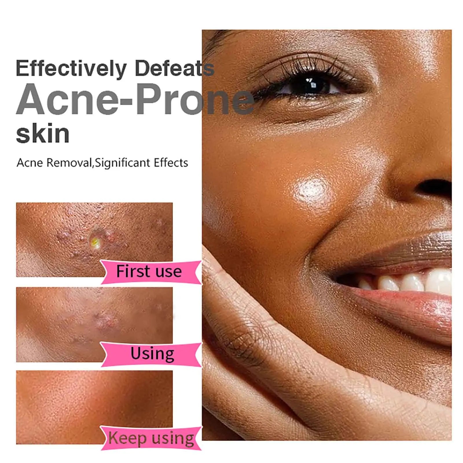 Organic Acne Face Cream, Cleaning Skin, Remove Blemish, Pimples, Non-Greasy, Oil Control, for Women and Men
